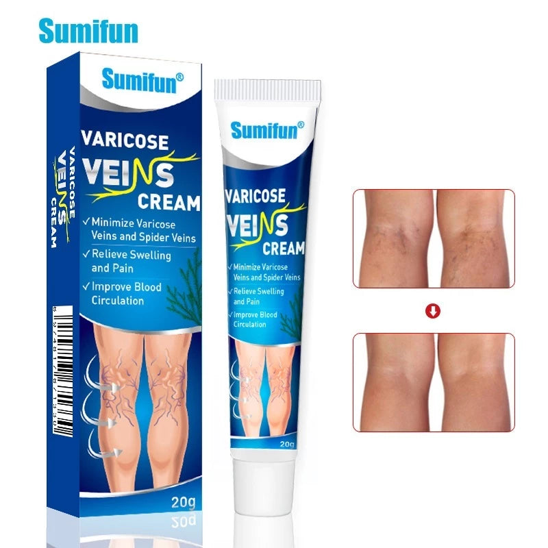 Sumifun Varicose Veins Cream Varicose Veins Remover 20g