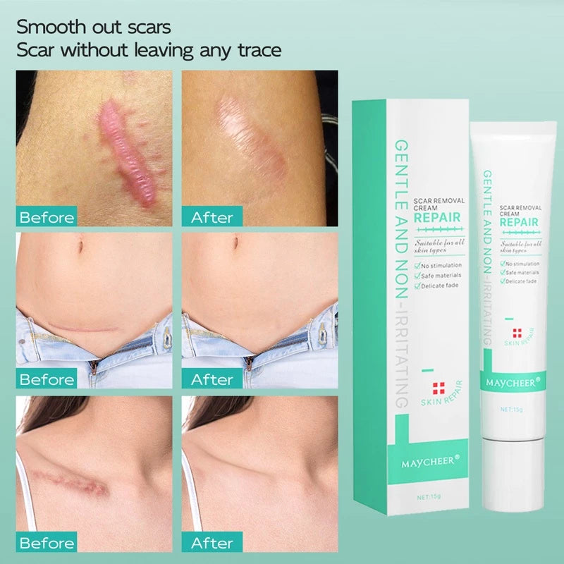Maycheer Gentle and Non-Irritating Scar Removal Cream Repair 15g
