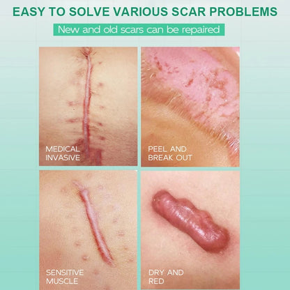 Maycheer Gentle and Non-Irritating Scar Removal Cream Repair 15g