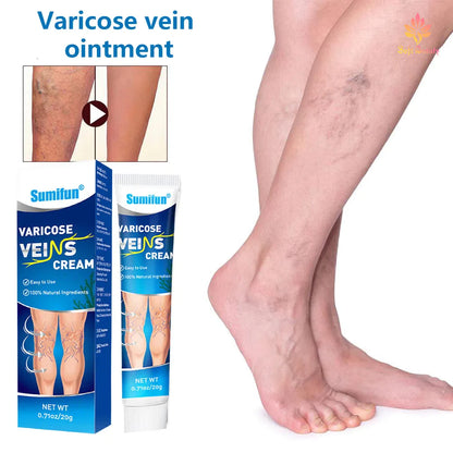 Sumifun Varicose Veins Cream Varicose Veins Remover 20g