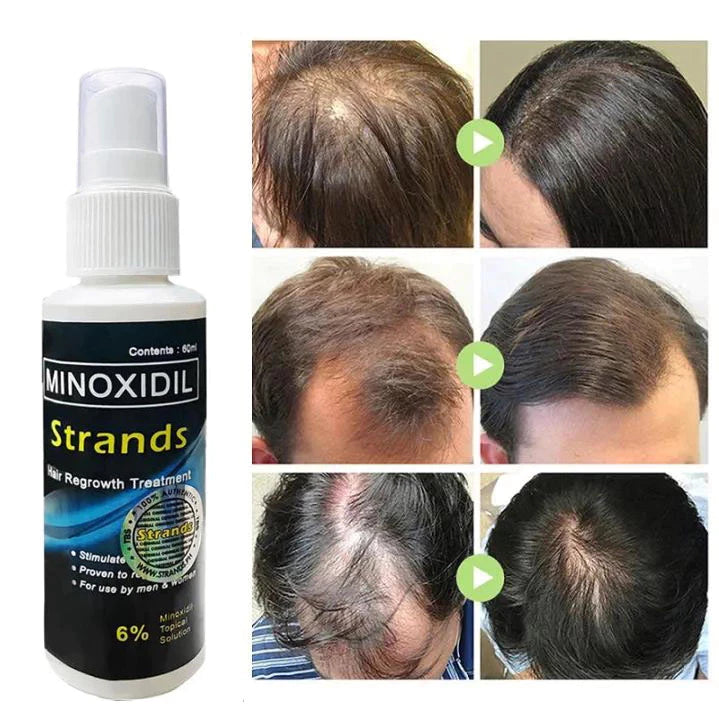 Minoxidil Strands Hair Regrowth Treatment