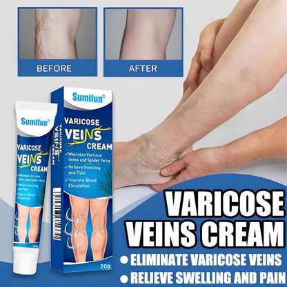 Sumifun Varicose Veins Cream Varicose Veins Remover 20g