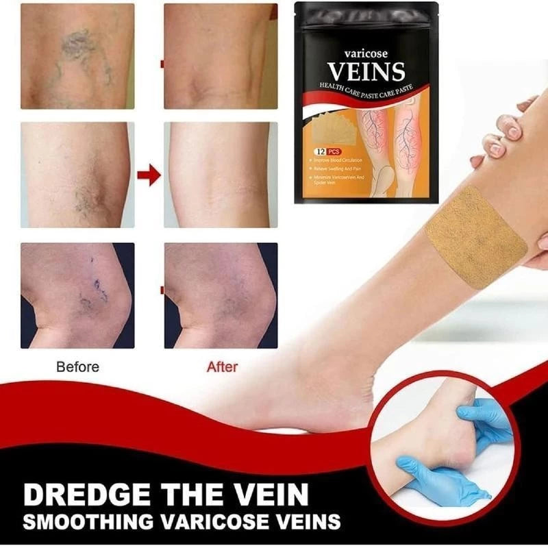 Varicose Veins Remover Patch Smoothes the Bulge of Blood Vessels (12pcs)