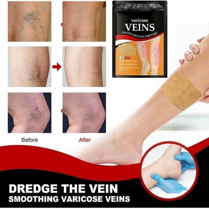 Varicose Veins Remover Patch Smoothes the Bulge of Blood Vessels (12pcs)